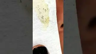 Black head removal on face - Blackheads on back treatment