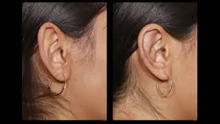 Reduction Otoplasty - Dr. John E Sherman
