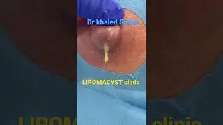 Massive infected cyst 