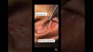 Ear extraction 