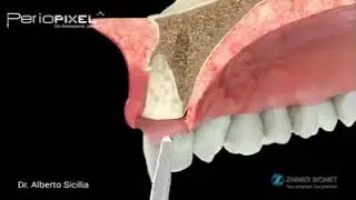Implante inmediato en alvéolos con ausencia de pared vestibular - PerioPixel