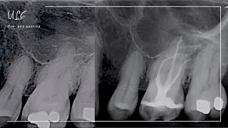 Endodontic treatment workflow - Part 2 - Irrigation, Obturation and Core Build Up