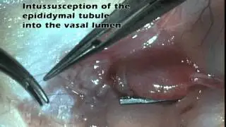 Microsurgical Vasoepididymostomy with a  Single-Armed Suture Technique