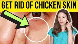 HOW TO GET RID OF CHICKEN SKIN UNDER EYES | Dermatologist