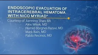 Endoscopic Evacuation of Intracerebral Hematoma using NICO Myriad