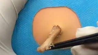 Treatment Of Blackhead Removal at Lam Dep Spa #052