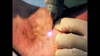 LASEmaR® 800 - Transdermal Laser for Spider Veins - Laser Transdermico Teleangectasie [Eufoton®]