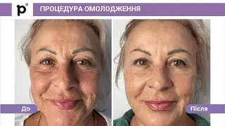 Омолоджуюча процедура