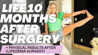 10 months post Lipedema surgery (physical results)