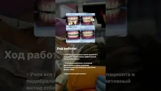 Кейс по реставрации и отбеливанию зубов  