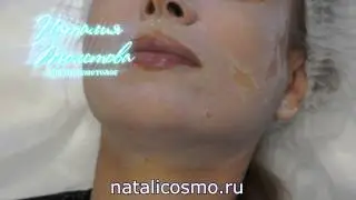 Серединный пилинг. Косметолог Наталия Толстова