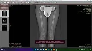 Cara menghitung sudut tulang femur dan pelvis dengan aplikasi Radiant DICOM Viewer