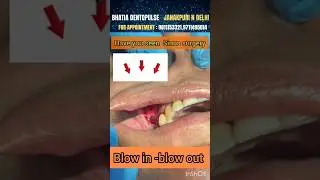 Sinus surgery -live