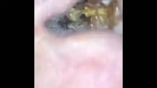 НОВОЕ ВИДЕО 2021  Прыщи давить залипательно