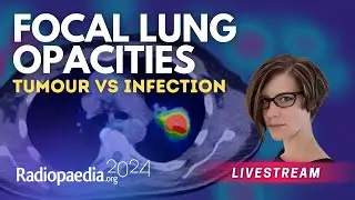 Focal lung opacities: tumour vs infection with​ Miranda Siemienowicz