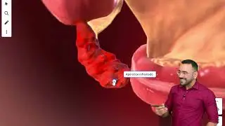 COMO É FEITO A CIRURGIA DE APENDICITE? (APENDICECTOMIA)
