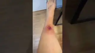 Infected softball-to-the-shin injury.