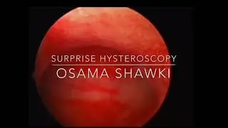 Surprise Hysteroscopy with Shawki