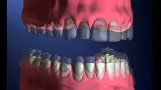 Denture Problems - Miskin Ajax Dental