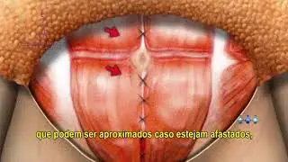 ABDOMINOSPLASTIA - Dra. Débora Tomatis Pacheco - Cirurgia Plástica - Porto Alegre/RS