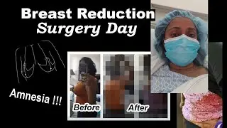 Breast Reduction Surgery Day | Immediate Before & After | PalsLivesLife