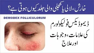 Demodex Folliculorum | Symptoms, Causes, and Treatment | Urdu/Hindi