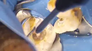 Dr. Mina's case YT #3 :  Retrieval of Extruded Gutta-percha beyond the apex in lower 2nd molar