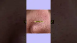 КОМЕДОНЫ, ЧЕРНЫЕ ТОЧКИ, СУХАЯ КОЖА. 😬 Как избавиться? В комментах названия