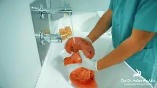 Dr.Aslan Abdulla - Mədə Xərcəngi,Total Qastroektomiya (open)