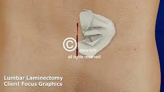 Lumbar Laminectomy Surgery Lumbar fusion L4 L5