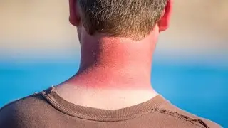 До чего может довести любовь к солнцу...