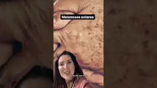 Que tipo de mancha eu tenho? #shorts #melasma #melasmatratamento