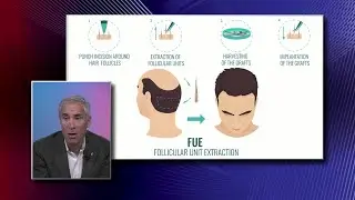 Follicular Unit Extraction