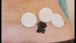 Комплексная Гирудотерапия