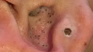 Ear Blackheads 2019 - Best Summer Blackhead Pops