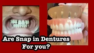 Questions about Snap in Dentures
