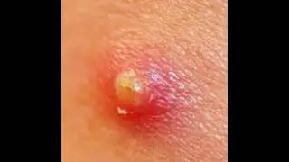 How To Treat And Cure Carbuncle
