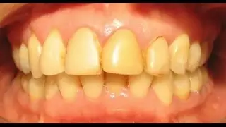 Como Blanquear los dientes -- PhotoShop Facil :V