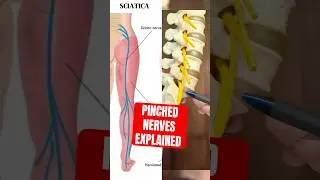 Pinched Nerves Explained 🤓