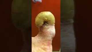 TOENAIL FUNGUS BEYOND ABILITY TO TREAT 😳 