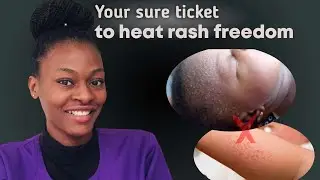 Heat Rash in Babies
