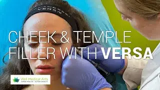 Versa Cheek & Temple Filler at Well Medical Arts in Seattle