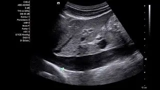 Abdomensonografie - Vena cava