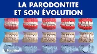 Gingivite, parodontite et son évolution ©