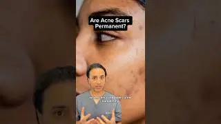 Are Acne Scars Permanent? Dr Solomon explains how to treat them | Dr. Medispa