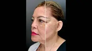Eyebrow lift, face lift, lower jaw, and neck lift by aptos thread #shorts #lift #facelift #threads