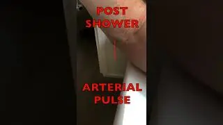 Blood Pulsing at Elbow after a Hot Shower