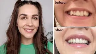 INVISALIGN REVIEW 🦷 everything you need to know | price, before and after
