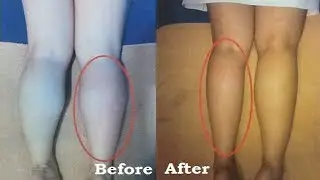 How I Slim Down My Calves & Thighs Fast | Workout at Home | My Calves Transformation
