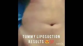 BRAZILIAN BUTT LIFT OR BBL SURGERY @SkintillateClinic